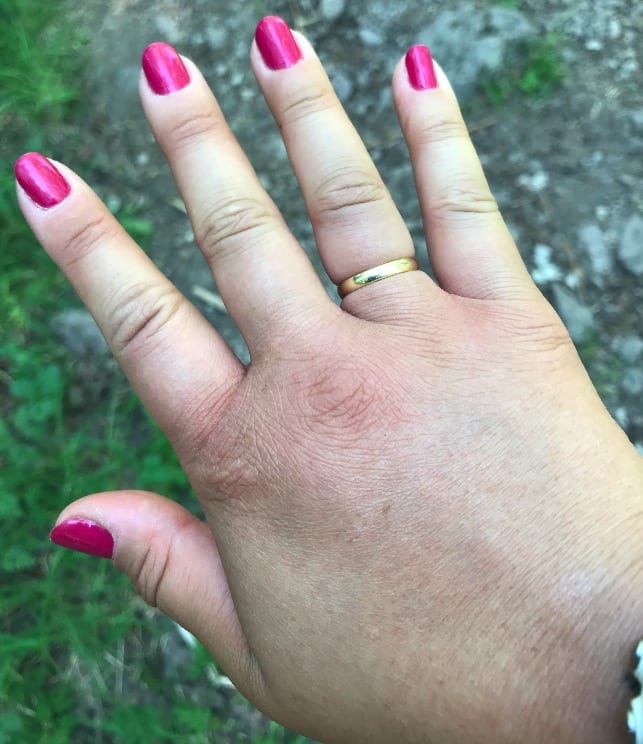 GLEMTE Å TA AV RINGEN: – Jeg prøvde å sitte stille, ha hånda høyt for å få ned blodet og trøkket i armen og jeg fikk av ringen til slutt, forteller Anna. Foto: Privat