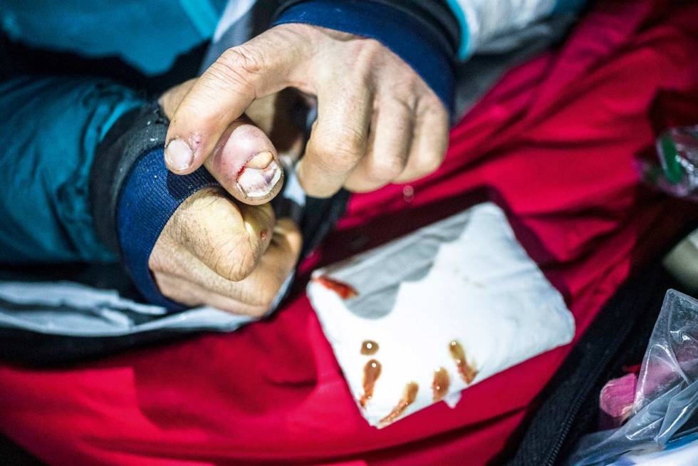 INFEKSJON: Mike fikk stygge frostskader på begge tomlene, som det gikk infeksjon i. Børge-Ousland-4