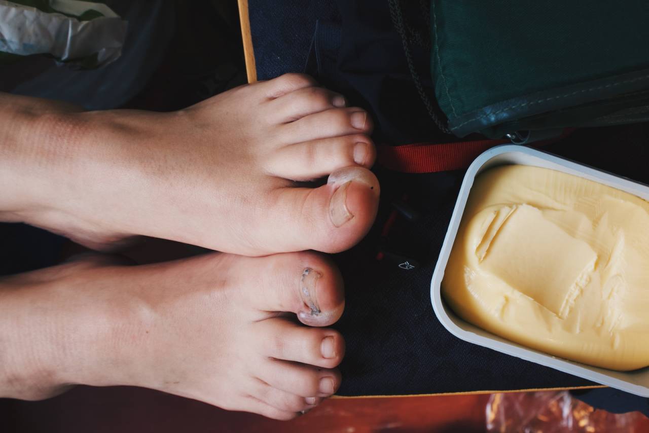 GNAGSÅR: Udelikate føtter med vannblemmer. Foto: Sunniva Sørheim gnagsår og vannblemmer på tur
